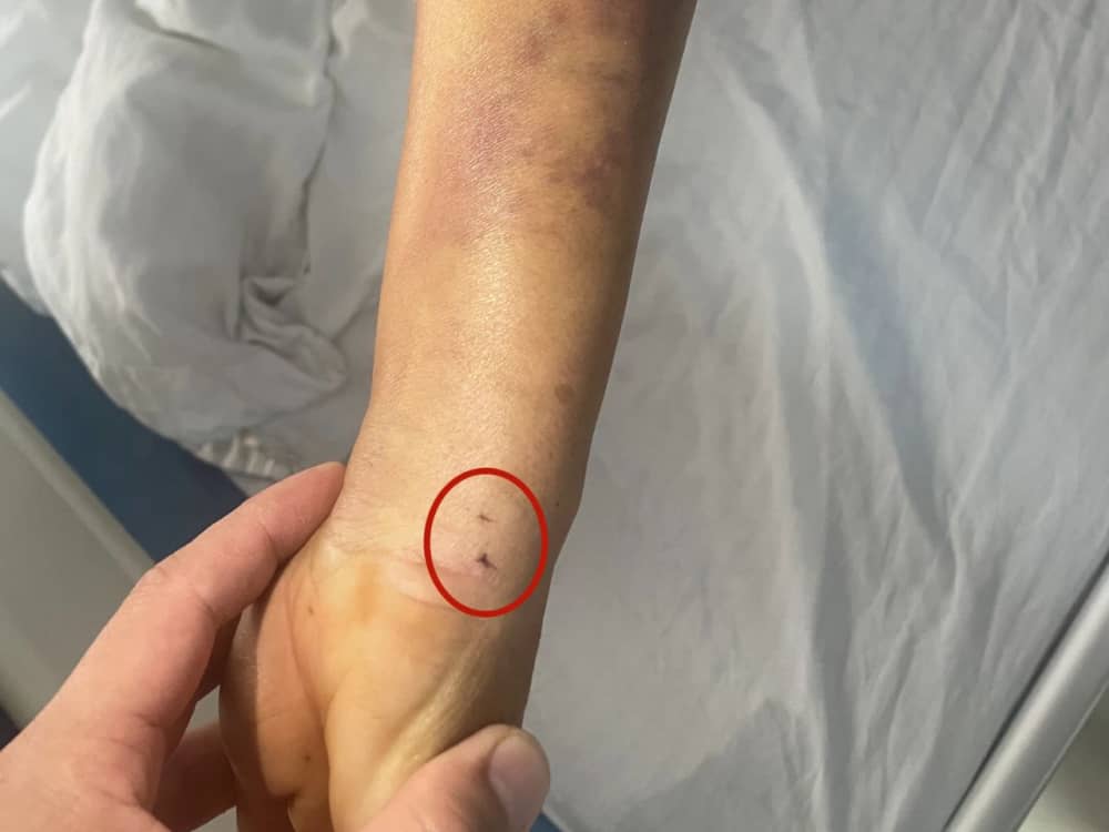 被蛇咬傷怎么辦？ 福德醫(yī)院教你毒蛇咬傷急救指南